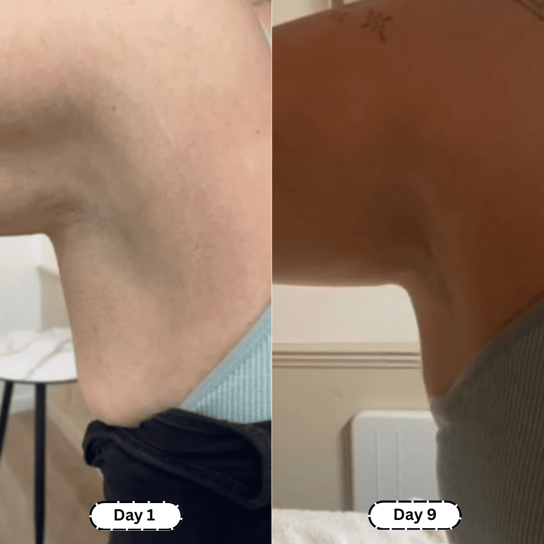 Lymphology – The #1 Patches for Reducing Armpit & Chin Puffiness