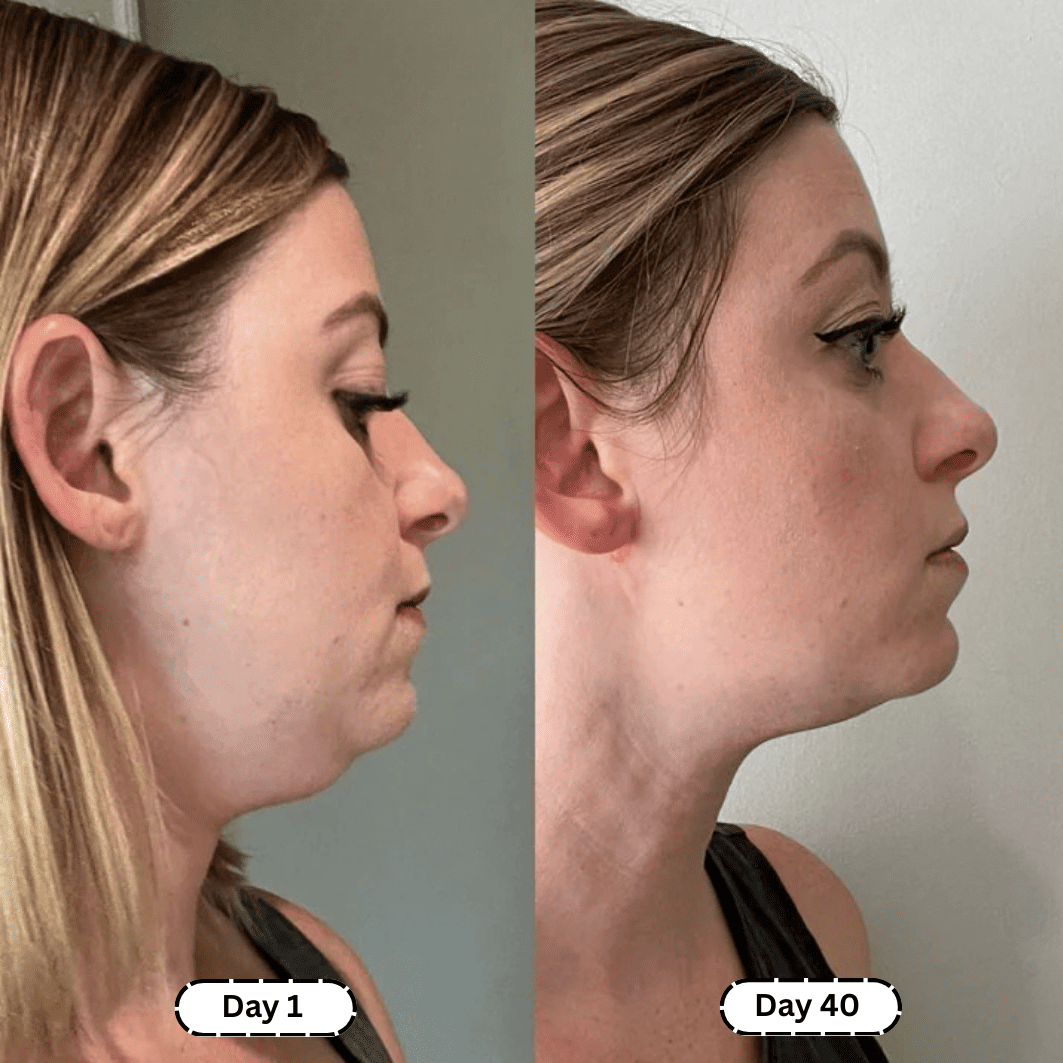 Lymphology – The #1 Patches for Reducing Armpit & Chin Puffiness